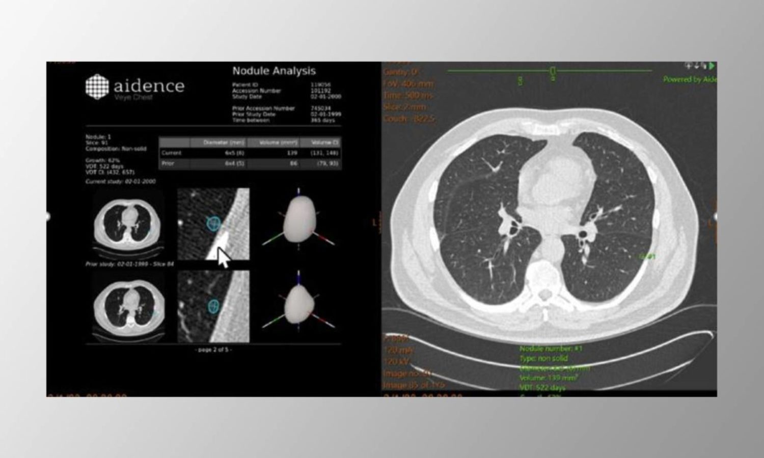 TMC secure even higher radiology quality with now 4 implemented AI solutions