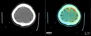 Aidoc-highlightings-a-subdural-haematoma-red-color.-300x120