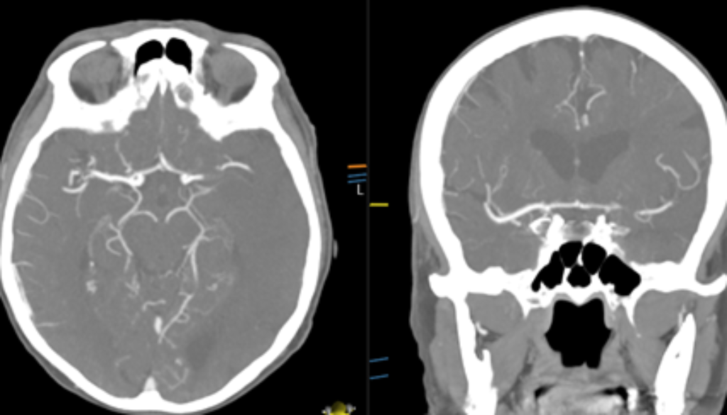 PerfusionCT2