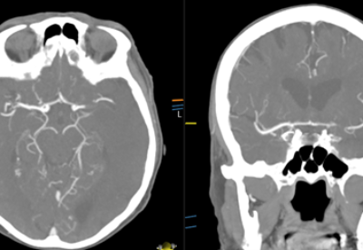 Perfusion CT – An Interview with Dr. Emily Clewett